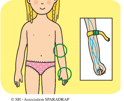 La prise de sang se fait sur la main ou au milieu du bras