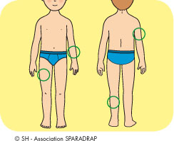 Les injections de toxine botulique se font dans certains muscles des bras et des jambes ?