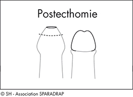 Schéma explicatif de la postecthomie
