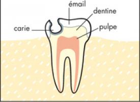 schema carie 