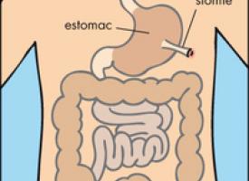 schéma de la gastrostomie