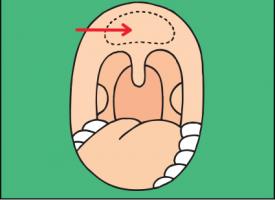 Schéma d'une bouche ouverte où sont indiquées les végétations