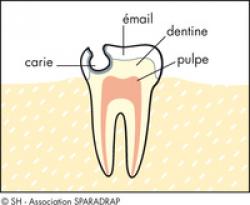 schema carie