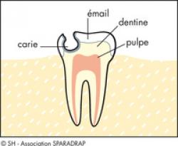 schema carie 