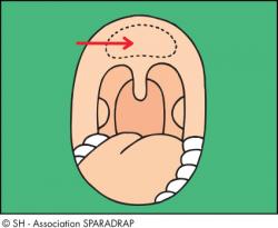 Schéma d'une bouche ouverte où sont indiquées les végétations