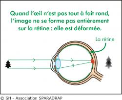 Schéma explicatif d'un oeil astigmate
